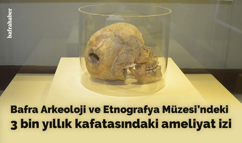 3 bin yıllık kafatasında ameliyat izi