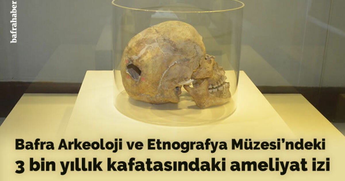 3 bin yıllık kafatasında ameliyat izi