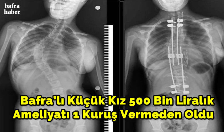 500 bin liralık ameliyatı 1 kuruş vermeden oldu - Samsun Eğitim ve Araştırma Hastanesi’nde ilk defa 10 yaşındaki bir çocuğa skolyoz (omurga eğriliği) ameliyatı yapıldı. Özel hastanelerde 300-500 bin TL arasında yapılan bu ameliyat kamu hastanesinde ücret alınmadan başarılı bir şekilde gerçekleştirildi.